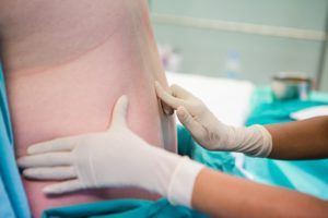 Cervical Epidural Injection