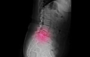 X-Ray Showing Injured Discs